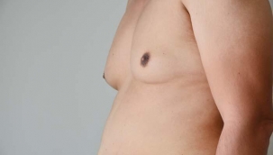 Erkeklerin yüzde 50’sinde jinekomasti görülüyor