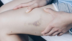 Varisler sadece estetik değil ciddiye alınması gereken bir sağlık sorunudur!