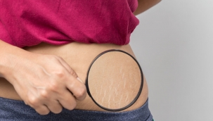 Cilt çatlakları nasıl geçer? İşte, çatlaklar için evde doğal çözüm yöntemleri