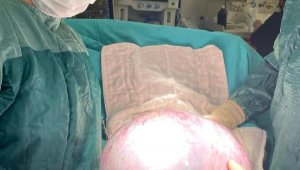 Karnından 9 kiloluk tümör çıktı