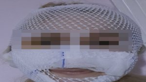 Yüzüne kimyasal madde atılan şiddet mağduru kadın, yaşadıklarını AA'ya anlattı: