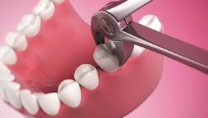 Kanşad Pala: “Günümüzde ağrılı/acılı diş çekimi neredeyse tarihe karıştı