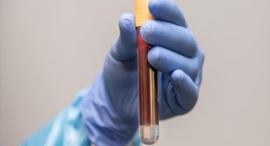 50-70 yaş arası erkeklere, prostat kanserine karşı yılda bir kez kan testi uyarısı