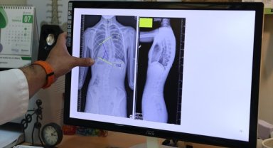 Çocuklarda ergenlik öncesi skolyoz kontrolü tedavi şansını artırıyor