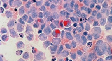 Lenf kanserleri ve akut lösemilerde erken tedavi önem taşıyor