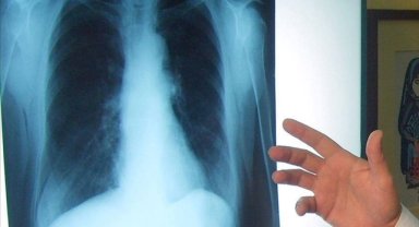 Ege Üniversitesinde borik asidin akciğer kanseri tedavisine yönelik etkisi araştırılacak