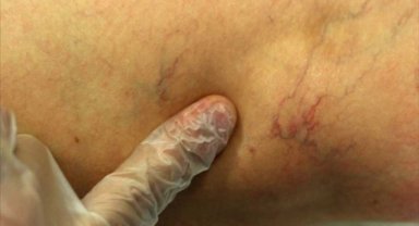 Önemsenmeyen bacak varisleri kalıcı hasarlara neden olabiliyor