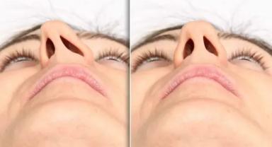 Deviasyon Nedir? Tedavisi ve Ameliyatı Nasıl Yapılır?