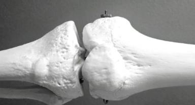 Osteoporoz: Belirti Vermeden İlerleyen Sessiz Tehdit