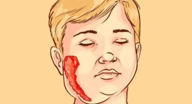 Kayserililerde En Çok Kabakulak Görülüyor: Önlem Şart!