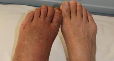 Bu Hastalığı Biliyor Musunuz? Tehlike Yaratıyor Mu?